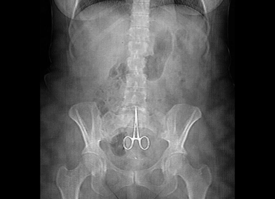 An X-ray shows a pair of surgical scissors in the abdomen of Anne, a woman in Lyon, France, who complained of abdominal pain after a surgery. Five months after the operation, Anne realized the scissors had been forgotten in her womb when the point of the scissors pierced her navel following a coughing fit. 