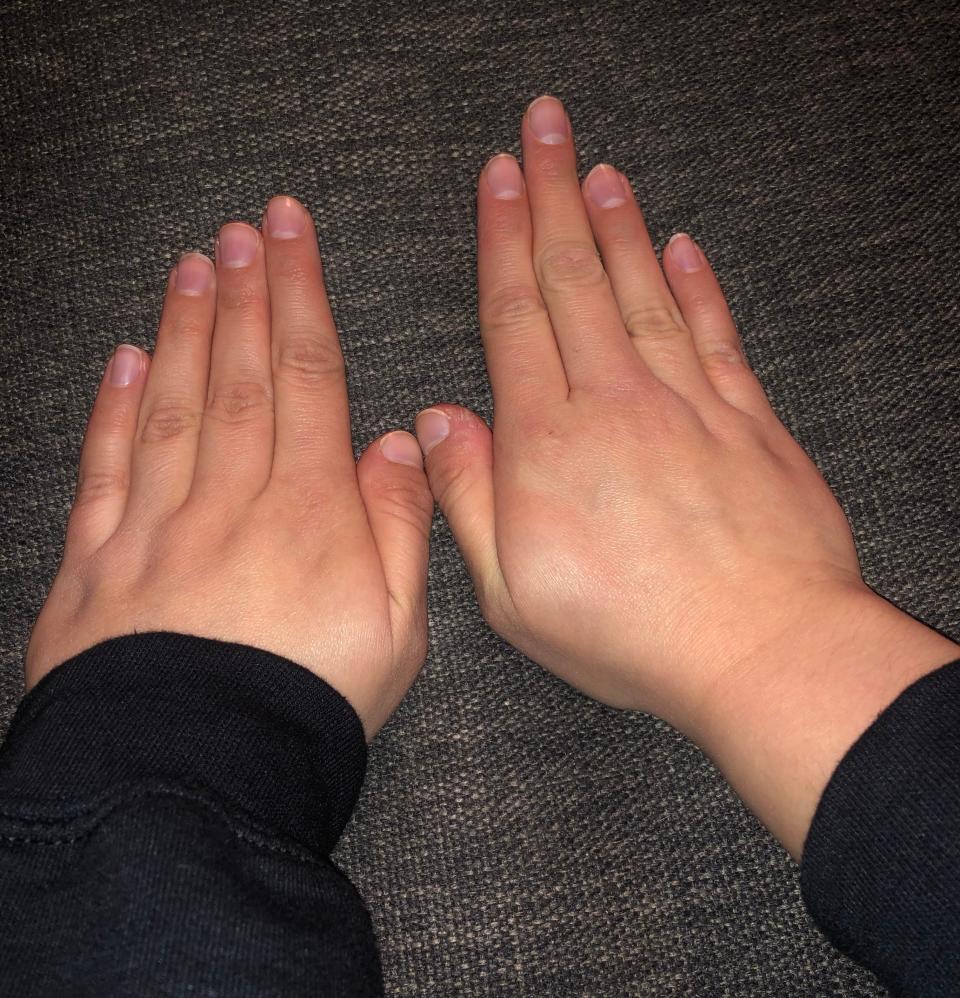 A person with two different sets of fingers