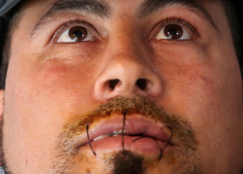 Hasni Abderrazzek, an asylum seeker, is seen with his lips sewed together in Brussels