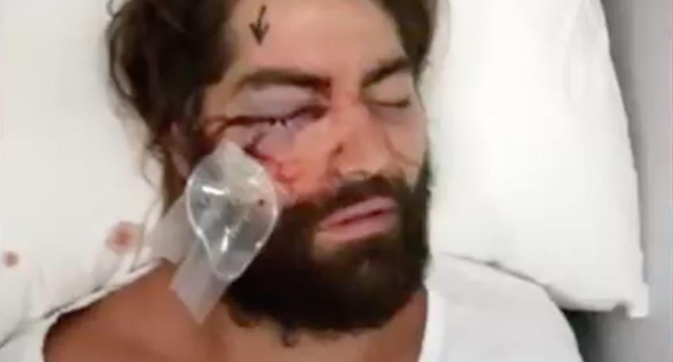 Brent Moresco, 20, and Bradley Elmore-Jeffries, 22, will serve jail time for bashing Melbourne man Elliot Harvey at a Brunswick night club because they didn't like his man-bun leaving him blind in one eye. Source: 7 News