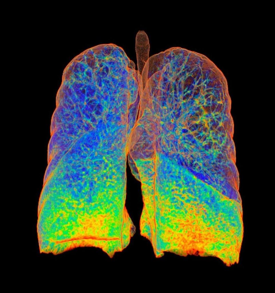 Pulmones de fumador