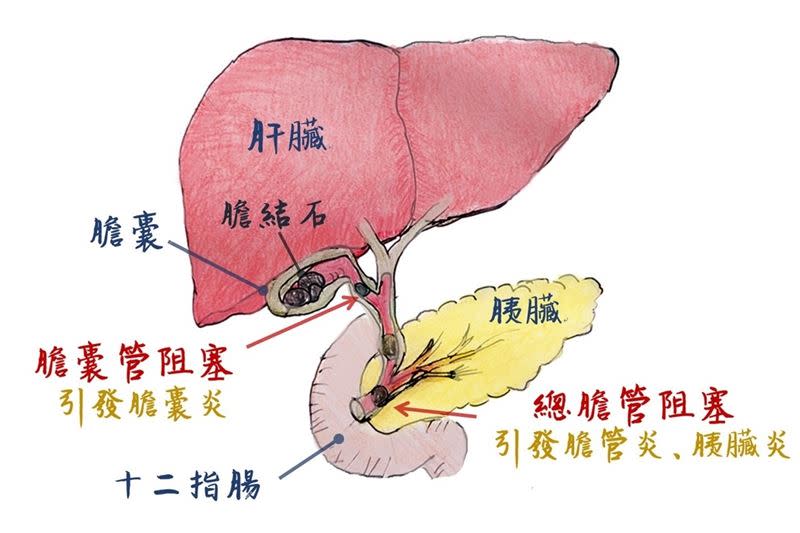 30歲莊先生曾因腹部不適，做了腹部超音波檢查，得知患有膽結石（圖／台北慈院提供）