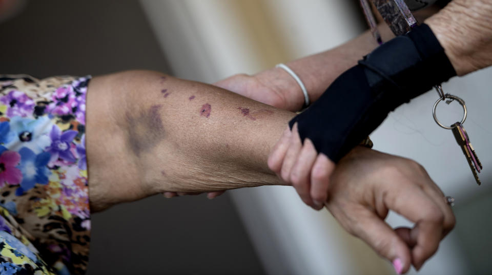 Elizabeth McCray, left, 87, recounts how her daughter's ex-boyfriend bit and bruised her arm in her Fontana, Calif., apartment home on Wednesday, Sept. 30, 2020. A friend Lorenza Marrujo came to her rescue. (Cindy Yamanaka/The Orange County Register/SCNG via AP)