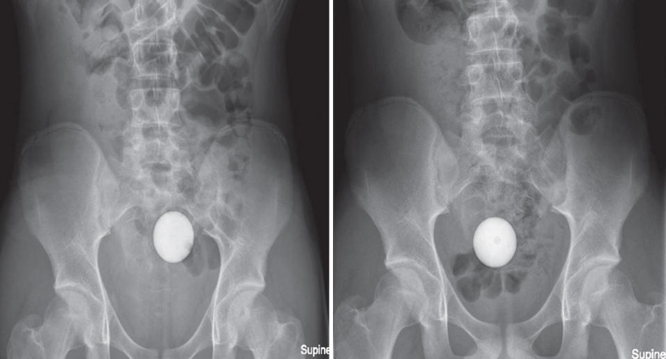 Two X-rays of a golf ball lodged in a 17-year-old boy's intestine. 