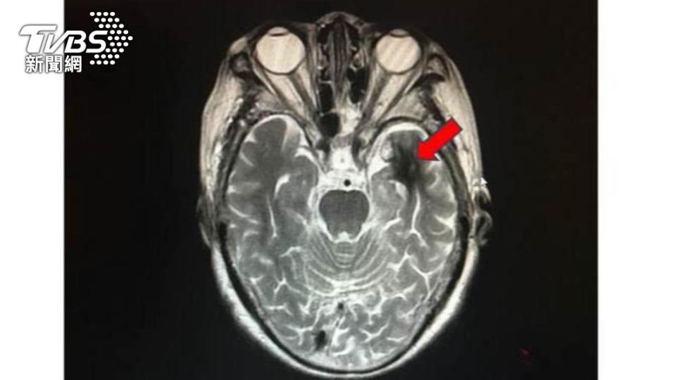 患者就醫後發現腦部有異常放電癲癇現象。（圖／診所提供）