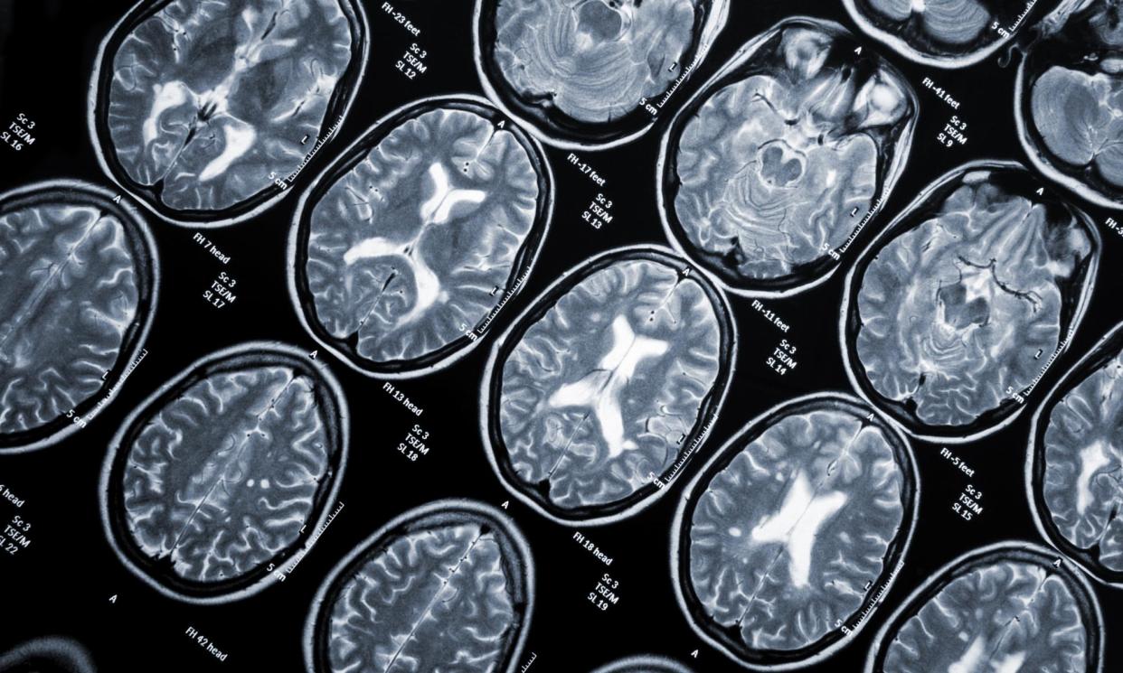 <span>A CT scan of the head of a young woman who has multiple sclerosis. The condition involves damage to myelin, an insulating layer around nerves including those in the brain.</span><span>Photograph: imageBroker/Rex/Shutterstock</span>