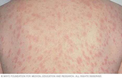 skin rashes pityriasis rosea