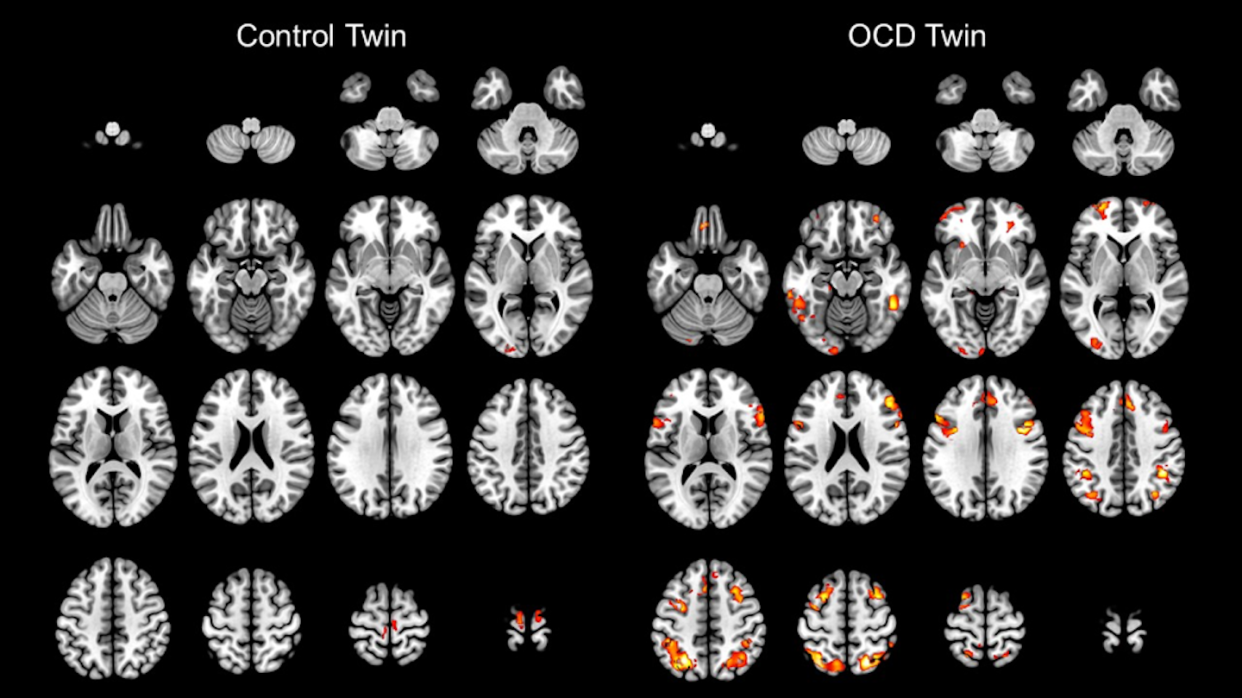 A pair of identical twins. The one on the right has OCD, while the one on the left does not. Brain Imaging Research Division, Wayne State University School of Medicine, <a href="http://creativecommons.org/licenses/by-sa/4.0/" rel="nofollow noopener" target="_blank" data-ylk="slk:CC BY-SA;elm:context_link;itc:0;sec:content-canvas" class="link ">CC BY-SA</a>