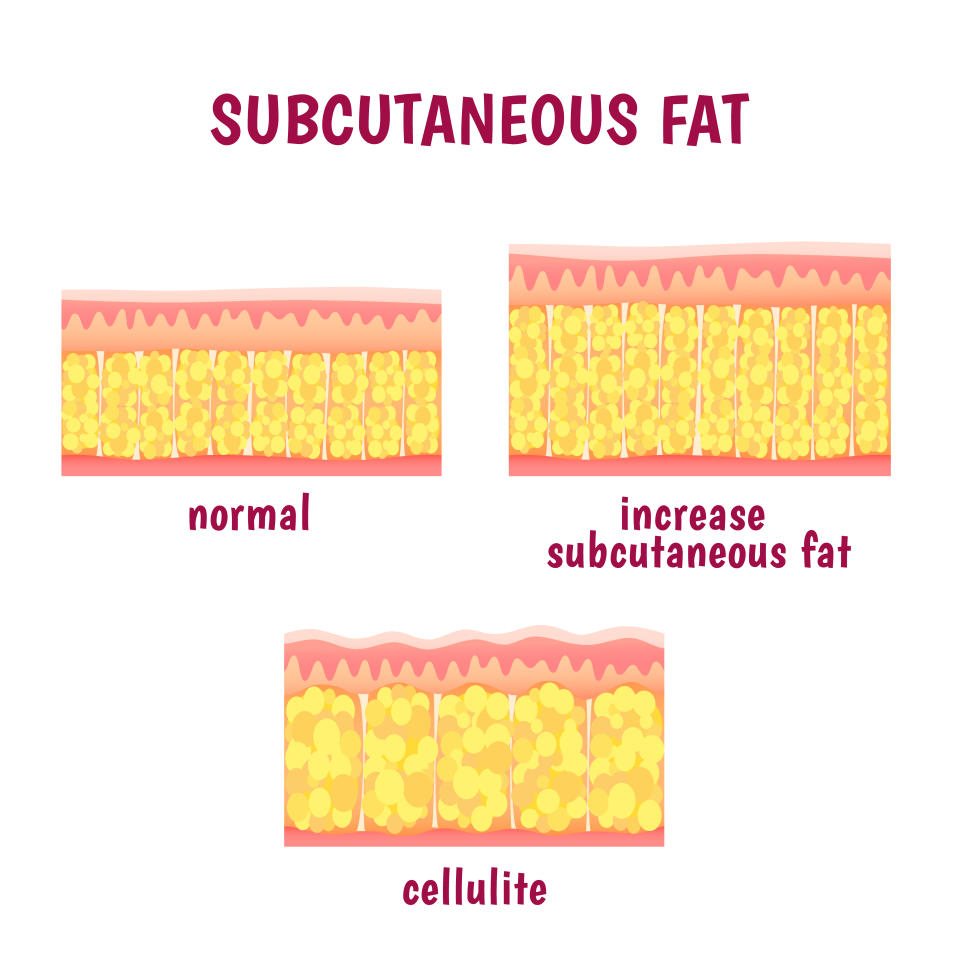 Different kinds of subcutaneous fat