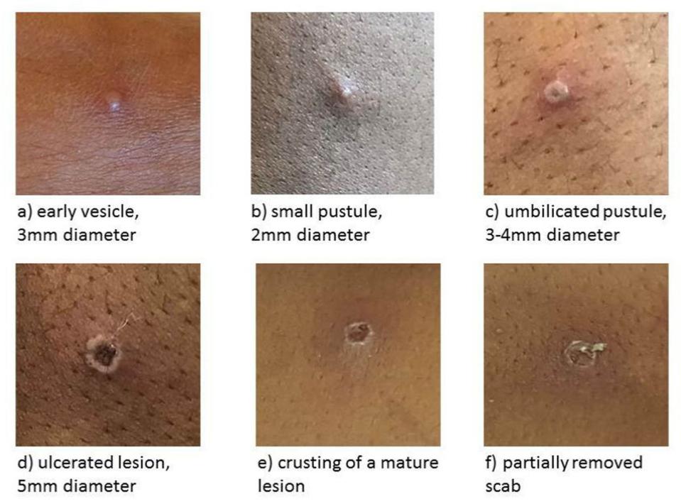 The stages of a monkeypox lesion (UKHSA/PA) (PA Media)