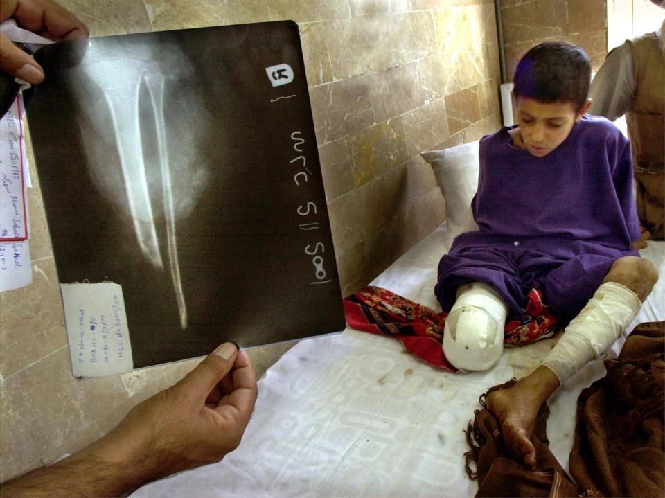 An X-ray shows the shattered leg of 10-year-old Sath Mohammad on Nov. 6, 2001, in Quetta, Pakistan.