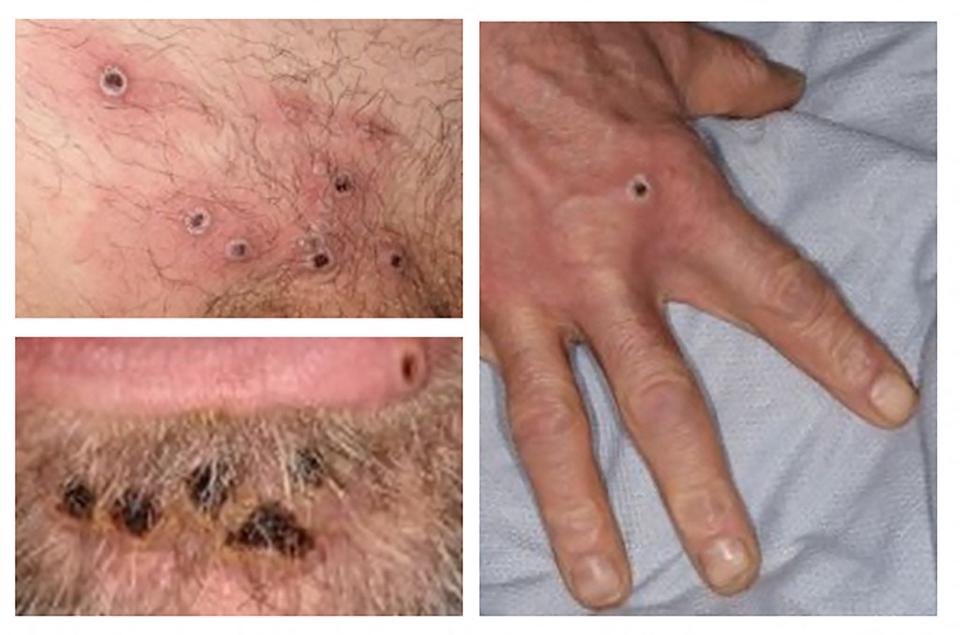 A handout picture made available by the UK Health Security Agency (UKHSA) on June 22, 2022, shows a collage of monkeypox rash lesions at an undisclosed date and location.