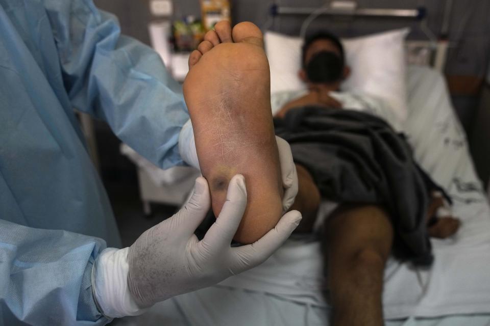 Un médico muestra una llaga en el pie de un paciente causada por viruela símica en el hospital Arzobispo Loayza en Lima, Perú, el martes 16 de agosto de 2022. (Foto AP/Martín Mejía)