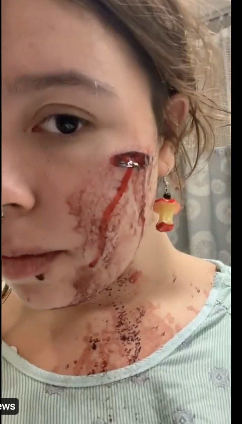 Lilli shared graphic images of her injuries after she was shot during the Highland Park 4th of July parade (Twitter)