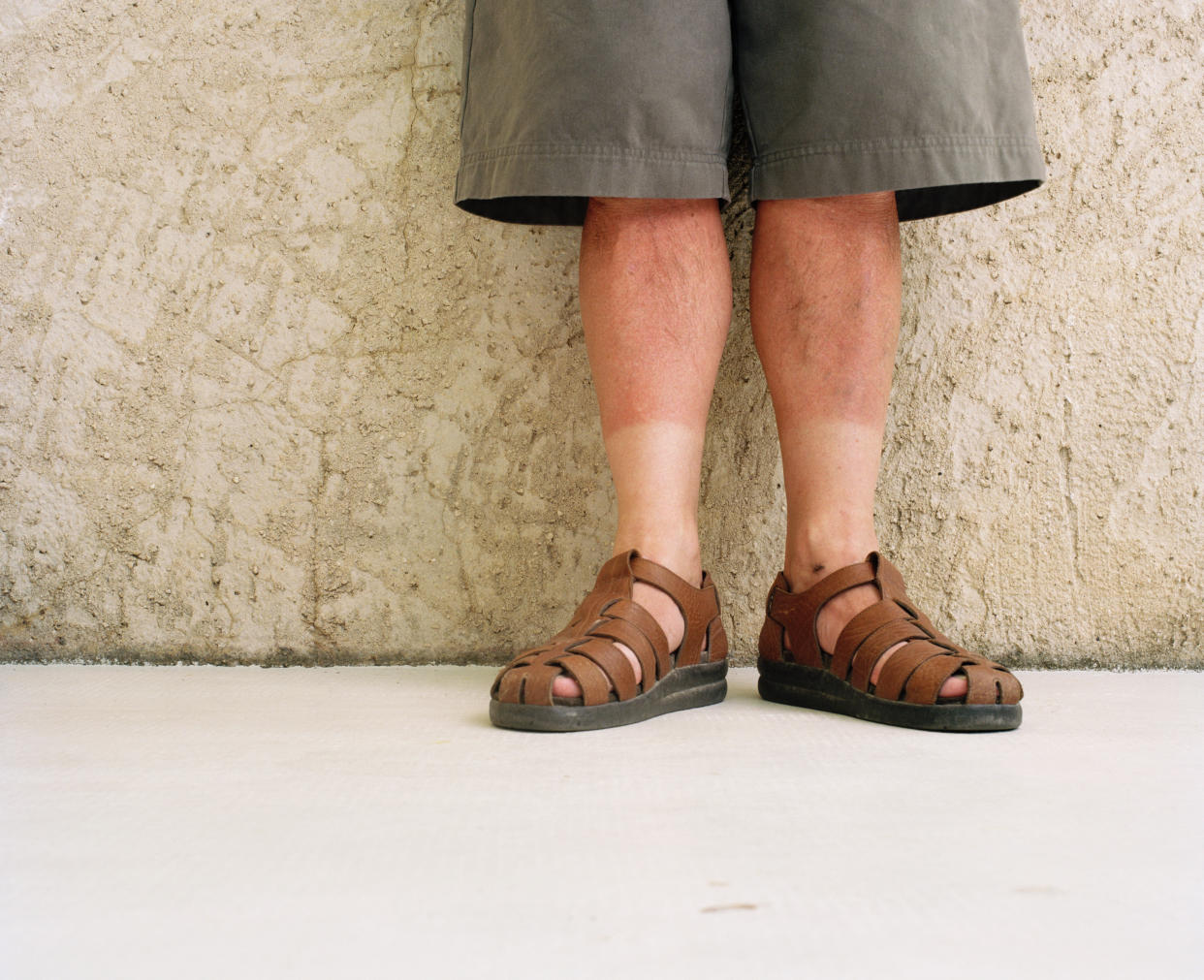 Men, wearing long shorts and sandals, showing sunburn on legs