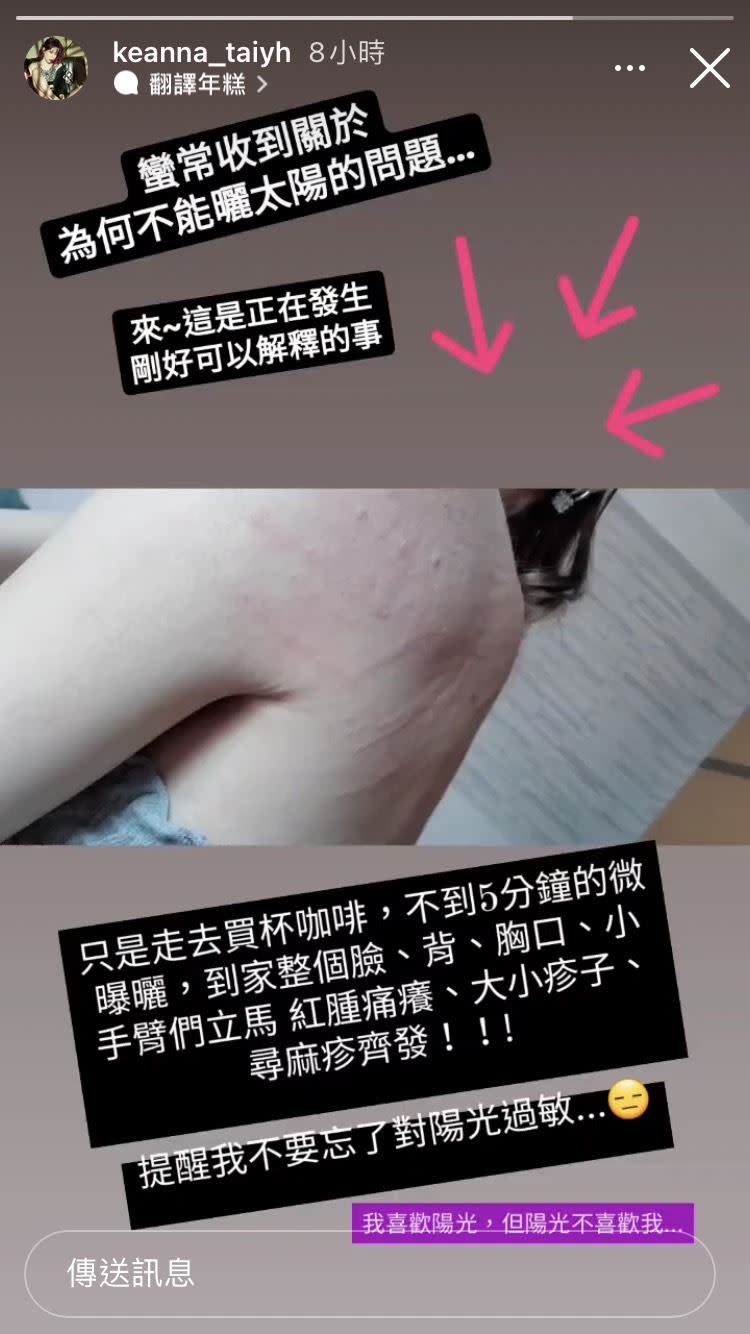 Keanna透露自己對陽光過敏，曬5分鐘就全身起紅疹。（圖／翻攝自  Instagram／keanna_taiyh）