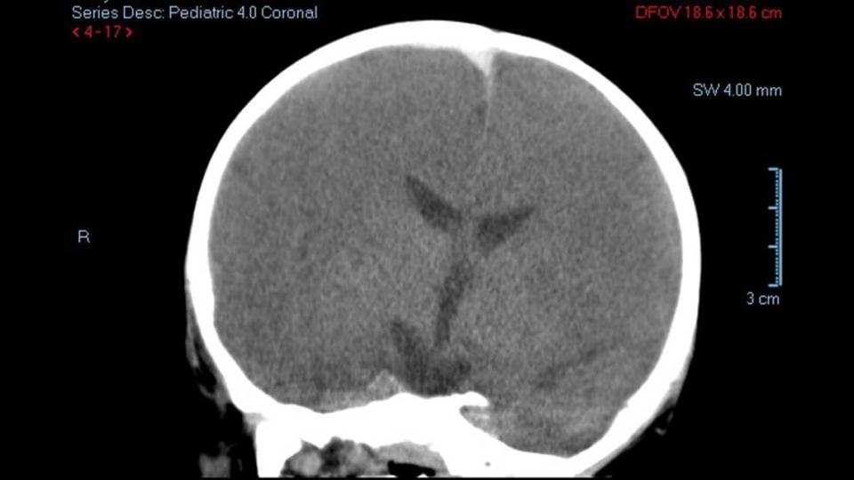 A pathologist testified that the small triangle at the top of this CT scan of Johnathan Swan’s head was a “massive subdural hematoma” that killed him.