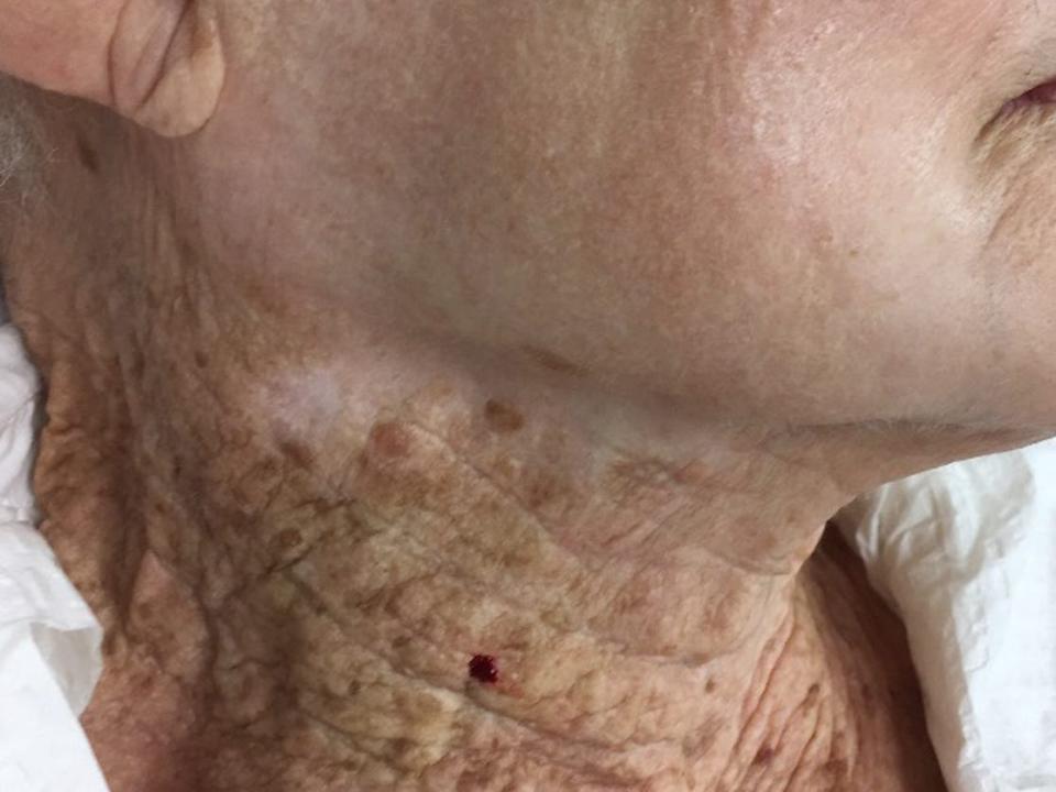 Photo showing sun damage to a woman's neck