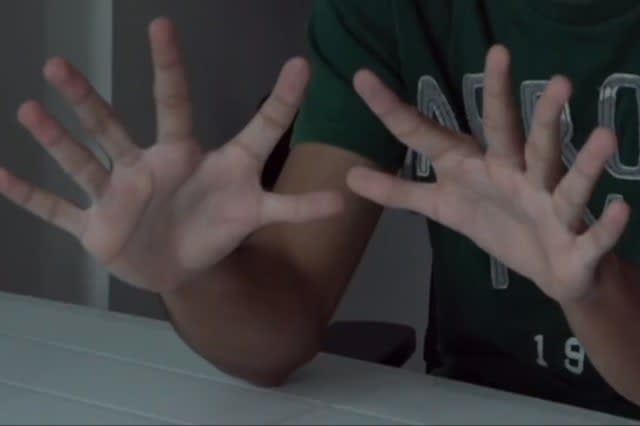 What's it like to live with six fingers?