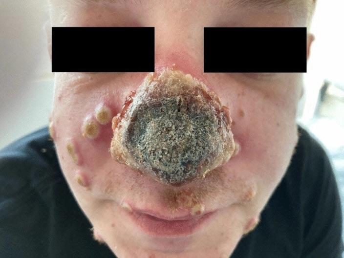 Graphic image: crusted nose from monkeypox infection