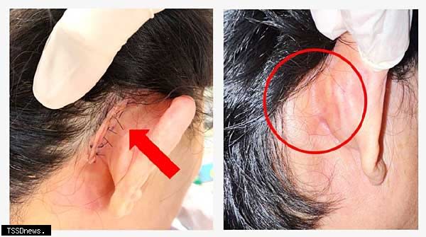 耳內視鏡微創技術圖：左為傳統手術（耳後五公分傷口，箭頭處）；右圖：微創手術（無傷口，圓圈處）。