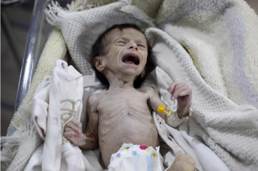 出生34天的新生兒照片，女孩名為Sahar，來自大馬士革近郊城鎮烏塔大馬士革（Ghouta）。（AFP PHOTO / Amer ALMOHIBANY）