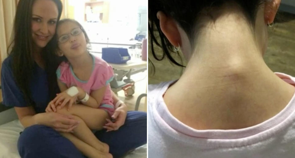 Belinda Yoon claims her 10-year-old daughter, Amber, was strung up by a skipping rope from a tree at Queen of Apostles Primary School in Riverton last week. Amber’s neck (right) after the alleged incident. Source: 7 News/ Sunday Times