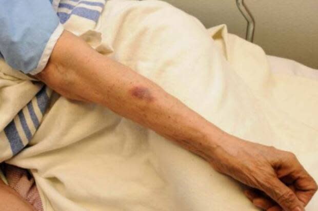 The 81-year-old victim suffered bruises during the attack.