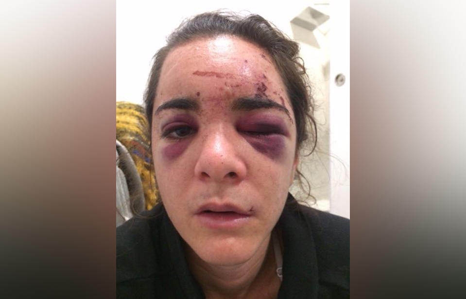 Rape victim Andrea Sicignano shared pictures of her bruised face and her story to raise awareness of the reality of sexual assault. Source: Andrea Sicignano / Facebook