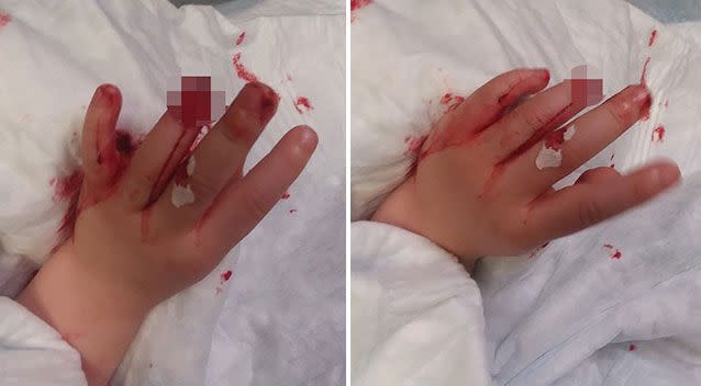 Erin Kays's daughter, Leigha, lost part of one of her left fingers in an accident at a childcare centre. Source: Facebook/ Erin Kays