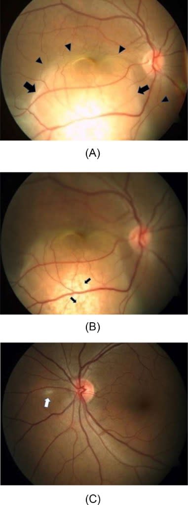 The woman went to the hospital for vision problems. Singh et al/ScienceDeirect