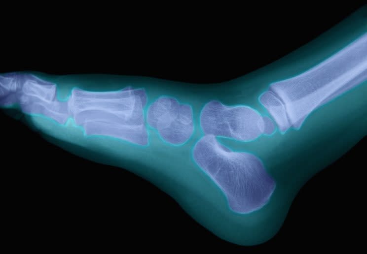 Weaker bones could lead to more fractures in future (Media for Medical / UIG/REX/Shutterstock)