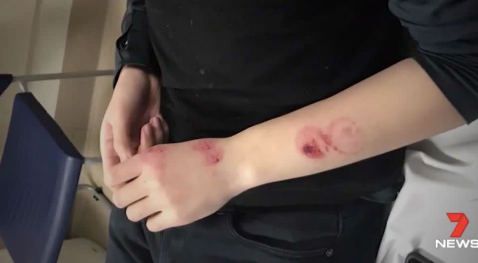 A waiter was left with deep bite marks on his arm. Source: 7 News