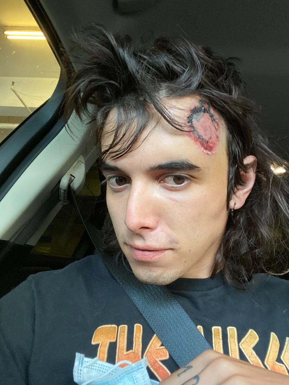 C.J. Montano, one week after attending a Los Angeles protest, where the police shot a projectile at his head. The former Marine was hospitalized in the intensive care unit due to bleeding in his brain. (Courtesy of CJ Montano)