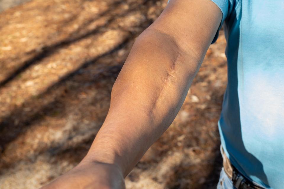 Gabino Ramos Hernandez holds out his scarred arm