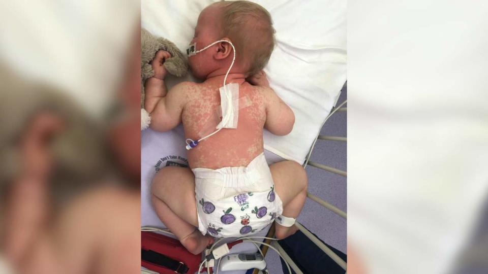 This Mother Has a Powerful Message for Anti-Vaxxers After Her Daughter Spent Her First Birthday With Measles