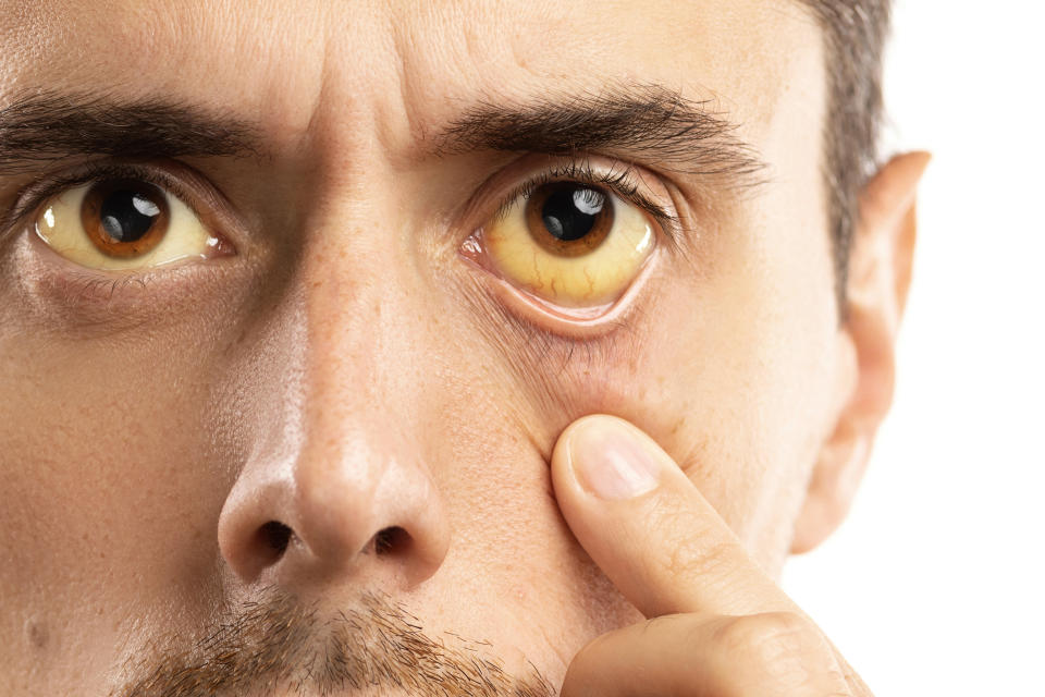 Los ojos amarillentos son signos de problemas con el hígado, infección viral u otra enfermedad. (Foto: Getty)