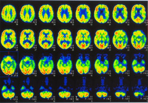 <span class="caption">An array of positron emission tomography or PET images.</span> <span class="attribution"><a class="link " href="https://www.shutterstock.com/download/confirm/1342194254?src=6eVUSiAiQ4Zne1Or8R9NMg-1-3&studio=1&size=medium_jpg" rel="nofollow noopener" target="_blank" data-ylk="slk:Yok_onepiece/Shutterstock;elm:context_link;itc:0;sec:content-canvas">Yok_onepiece/Shutterstock</a></span>