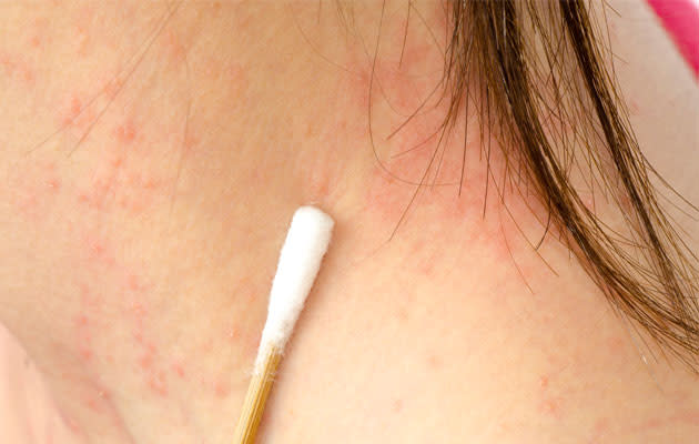 Typical psoriasis symptoms wax and wane. (Thinkstock photo)