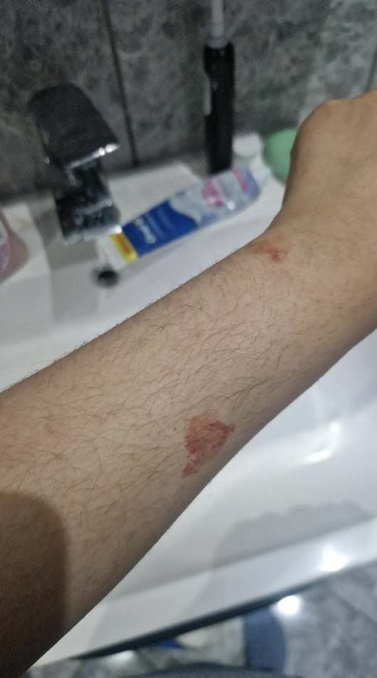 Person's arm with healing abrasions, near a bathroom sink with toiletries in the background