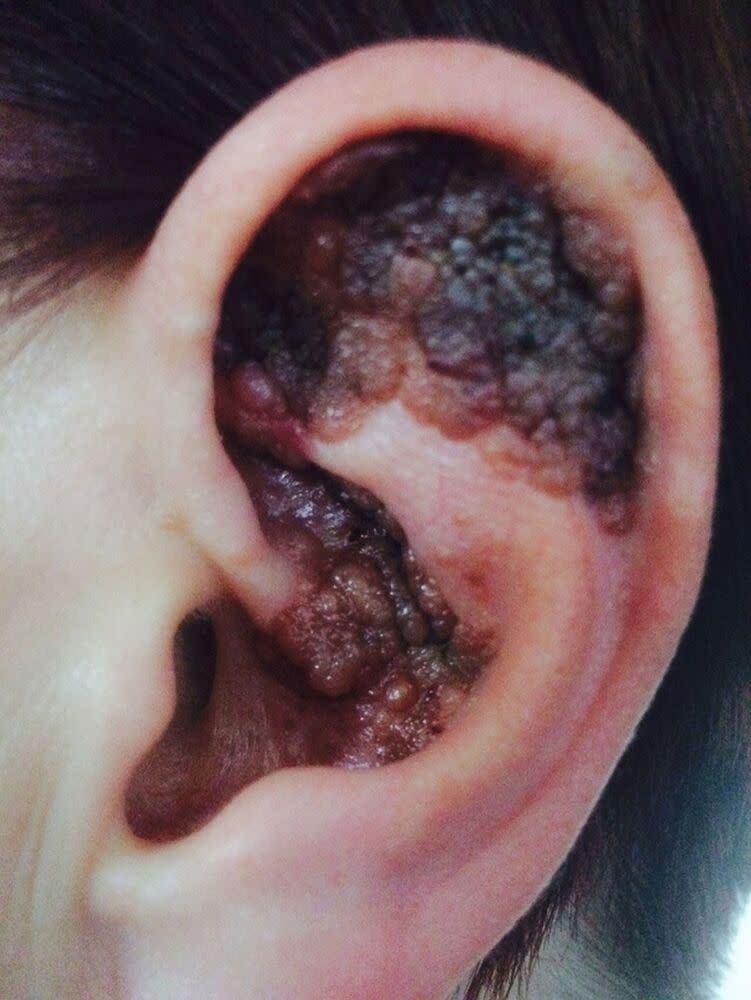 Anthea Smith's ear prior to amputation | Kennedy News and Media