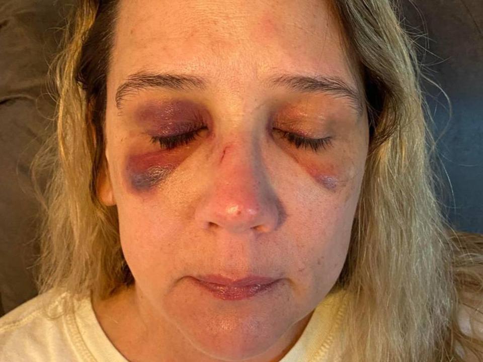 Michelle Audo pictured two days after being beaten by teens who wanted to fight her daughter (Michelle Audo / The Kansas City Star)