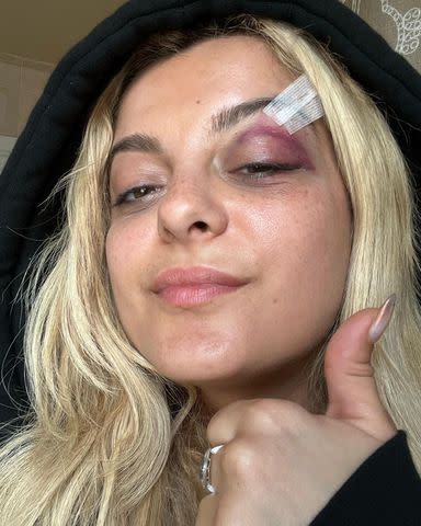 <p>Bebe Rexha/Instagram</p> Bebe Rexha shows her injury after being hit with a phone while performing.