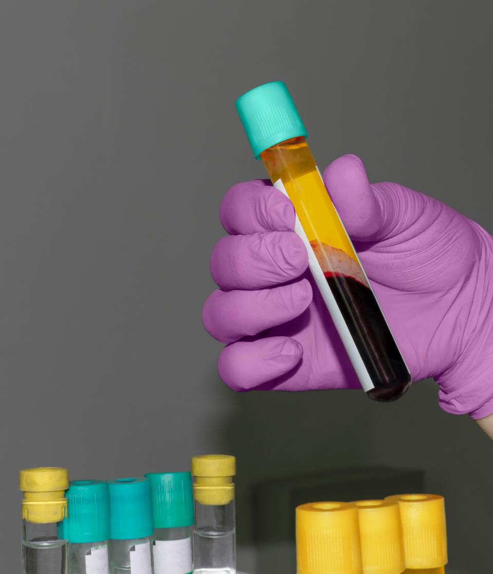 <h1 class="title">Test tube with plasma and blood in the doctors hand. Plasma with antibodies to Covid-19. PRP. Close up, copy space.</h1><cite class="credit">Getty Images</cite>