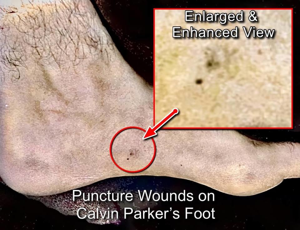 During their experience with the creatures, Parker and Hickson reported being pricked by a device. The wounds were visible during their medical exam in the days after the incident.