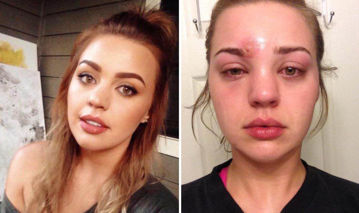 “Within an hour my entire face swelled up” [Photo: Katie Wright/Facebook]