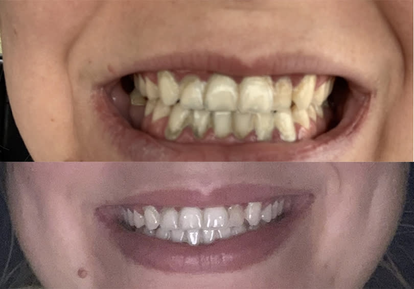 does led teeth whitening work reddit