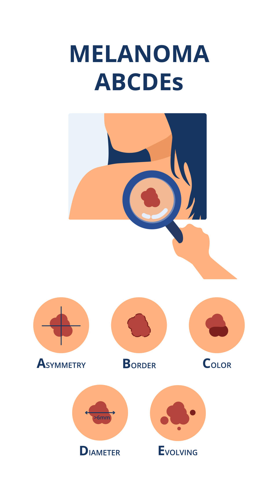 Melanoma ABCDEs symptoms like big diameter, asymmetry, uneven color, uneven border and evolving next to a hand of a doctor detecting a skin cancer spot on a person's back.