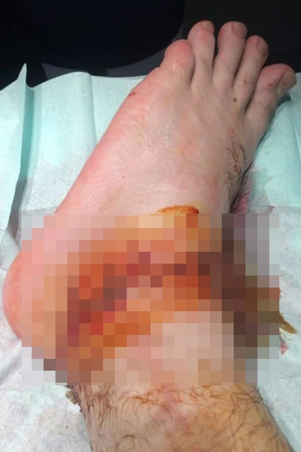 The victim feared he would lose his foot in the attack