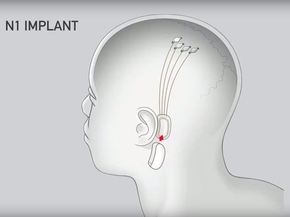 Neuralink chip